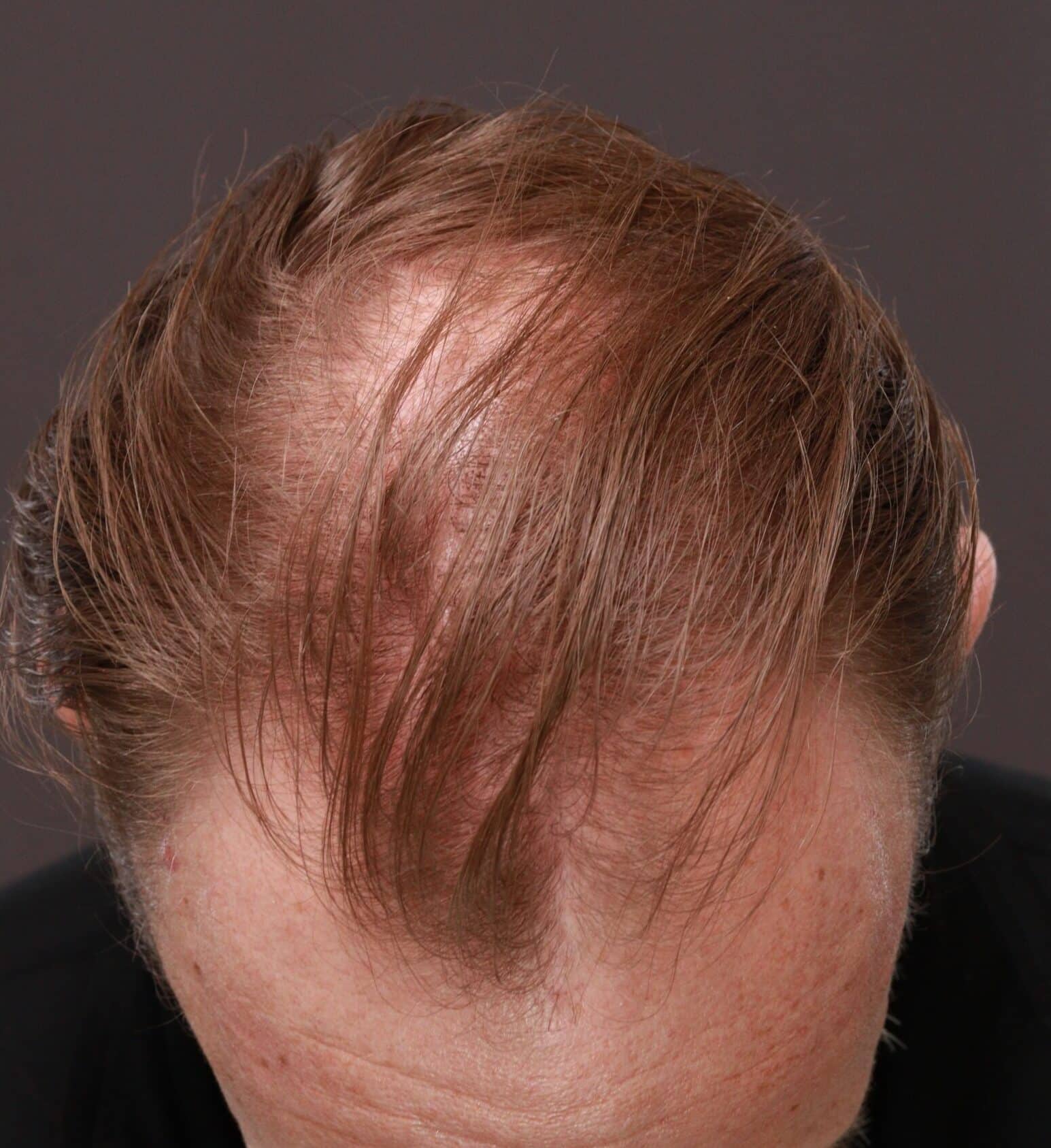 Before Image: FUE Hair Transplant by Dr. Thompson - front