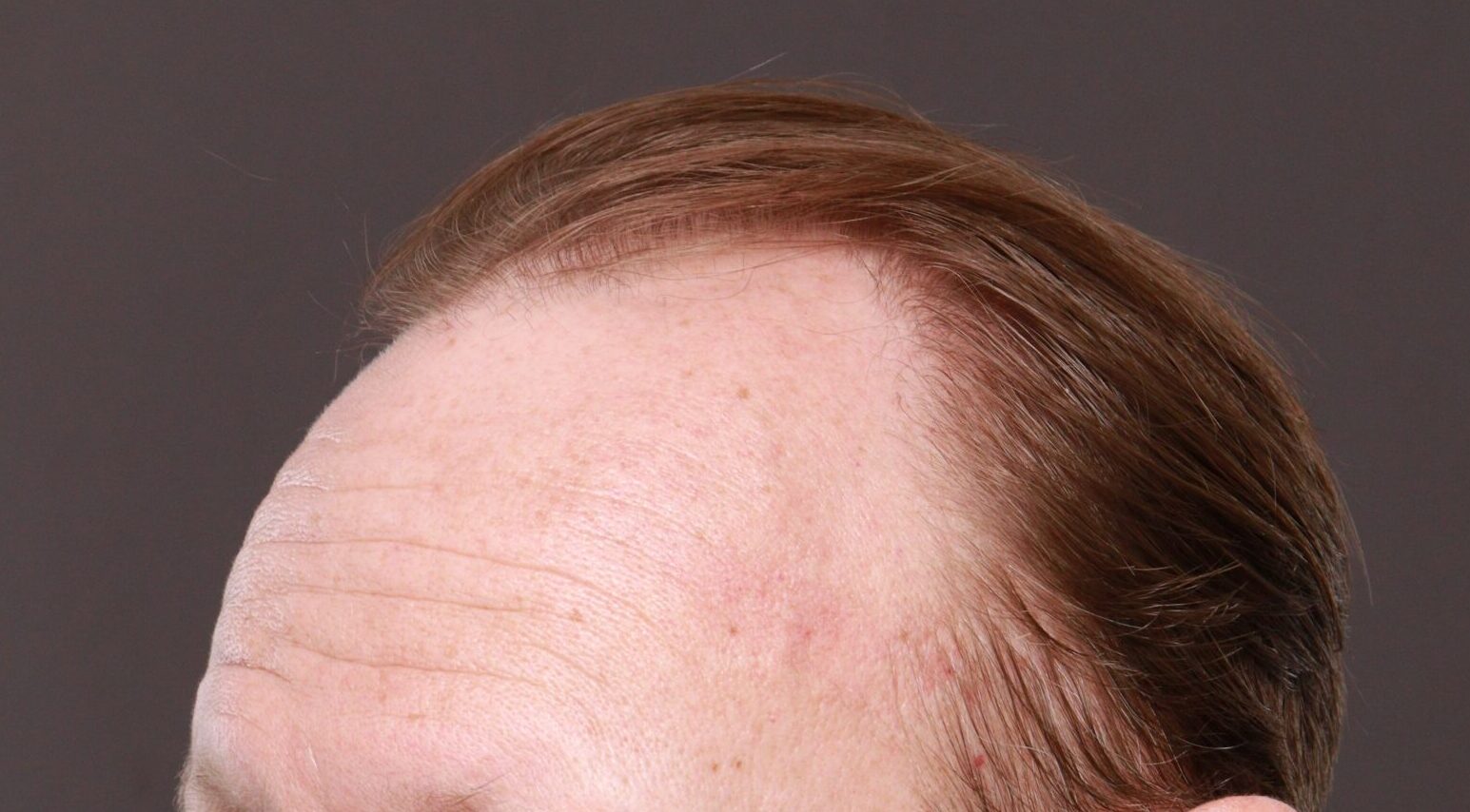 Before Image: FUE Hair Transplant by Dr. Thompson - left-front-oblique