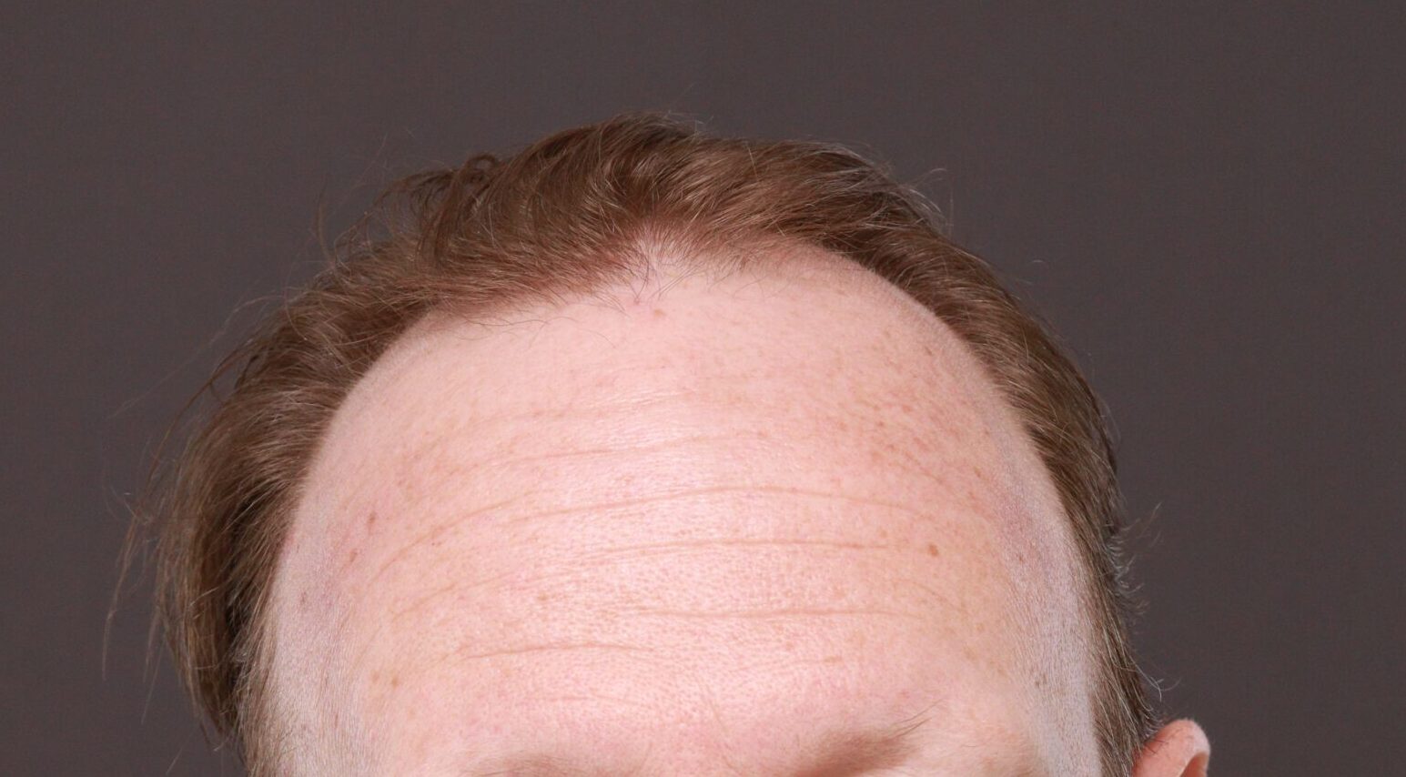 Before Image: FUE Hair Transplant by Dr. Thompson - front