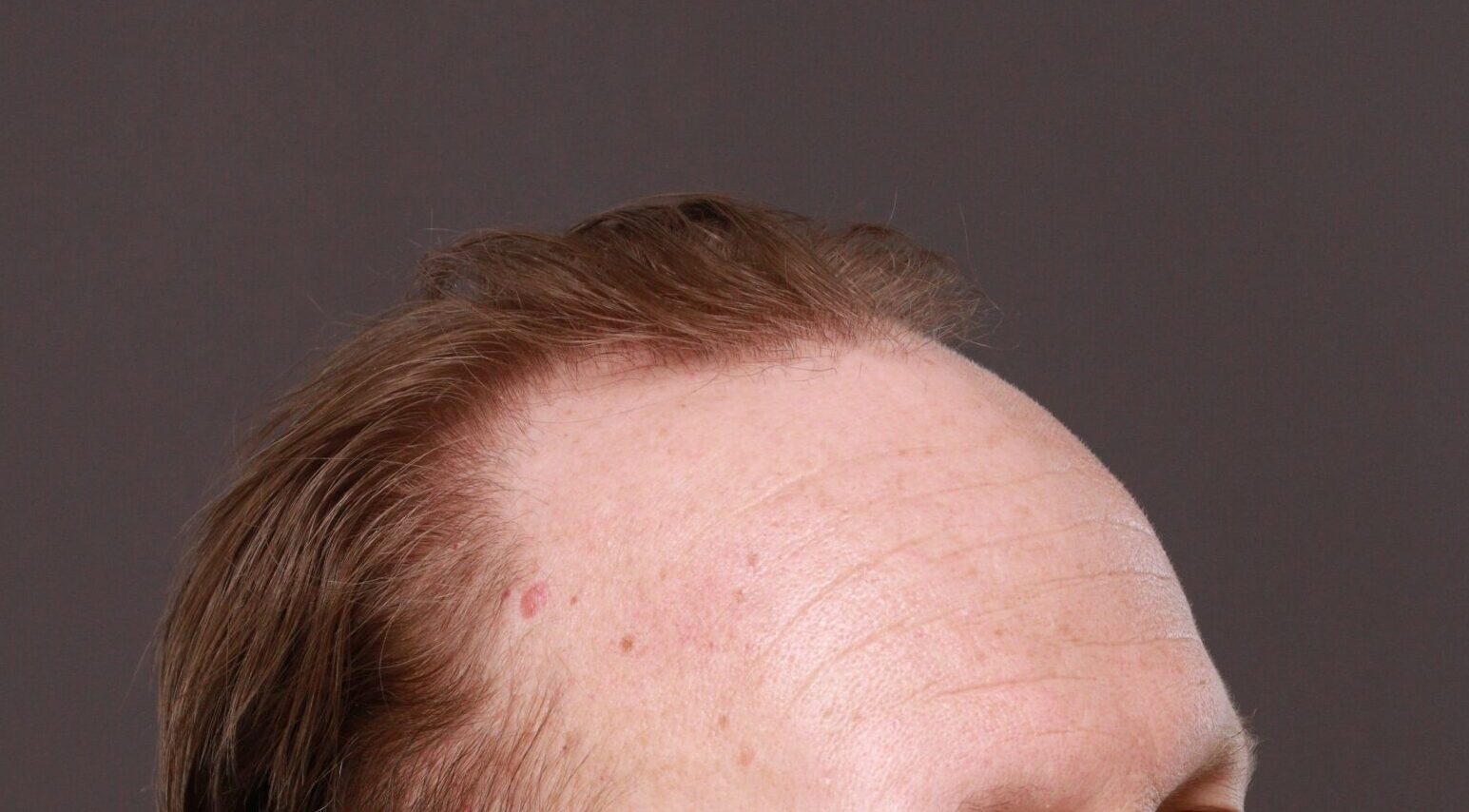 Before Image: FUE Hair Transplant by Dr. Thompson - right-side
