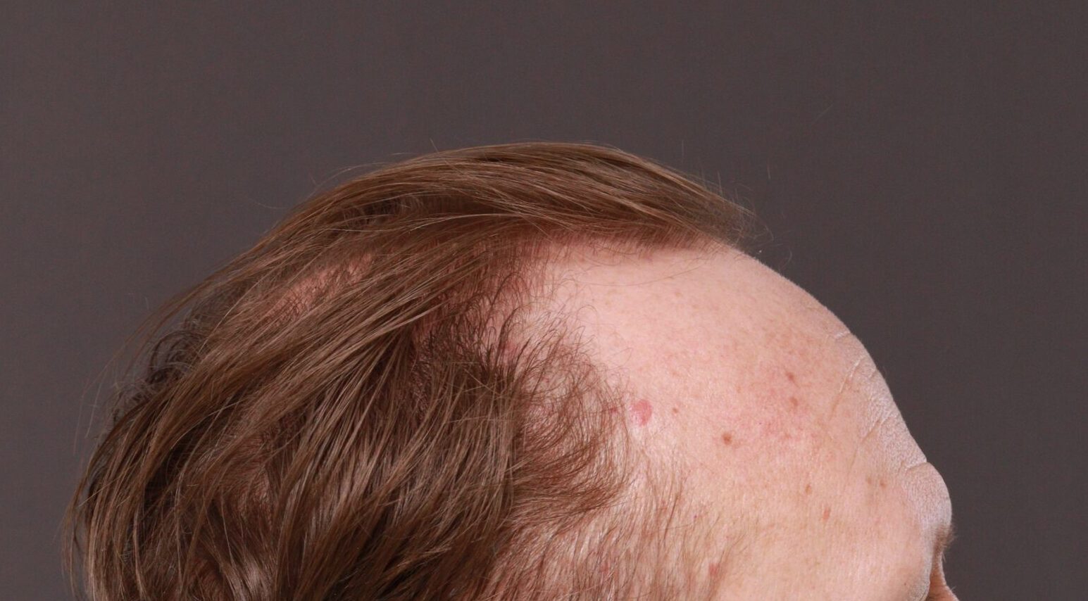 Before Image: FUE Hair Transplant by Dr. Thompson - right-side