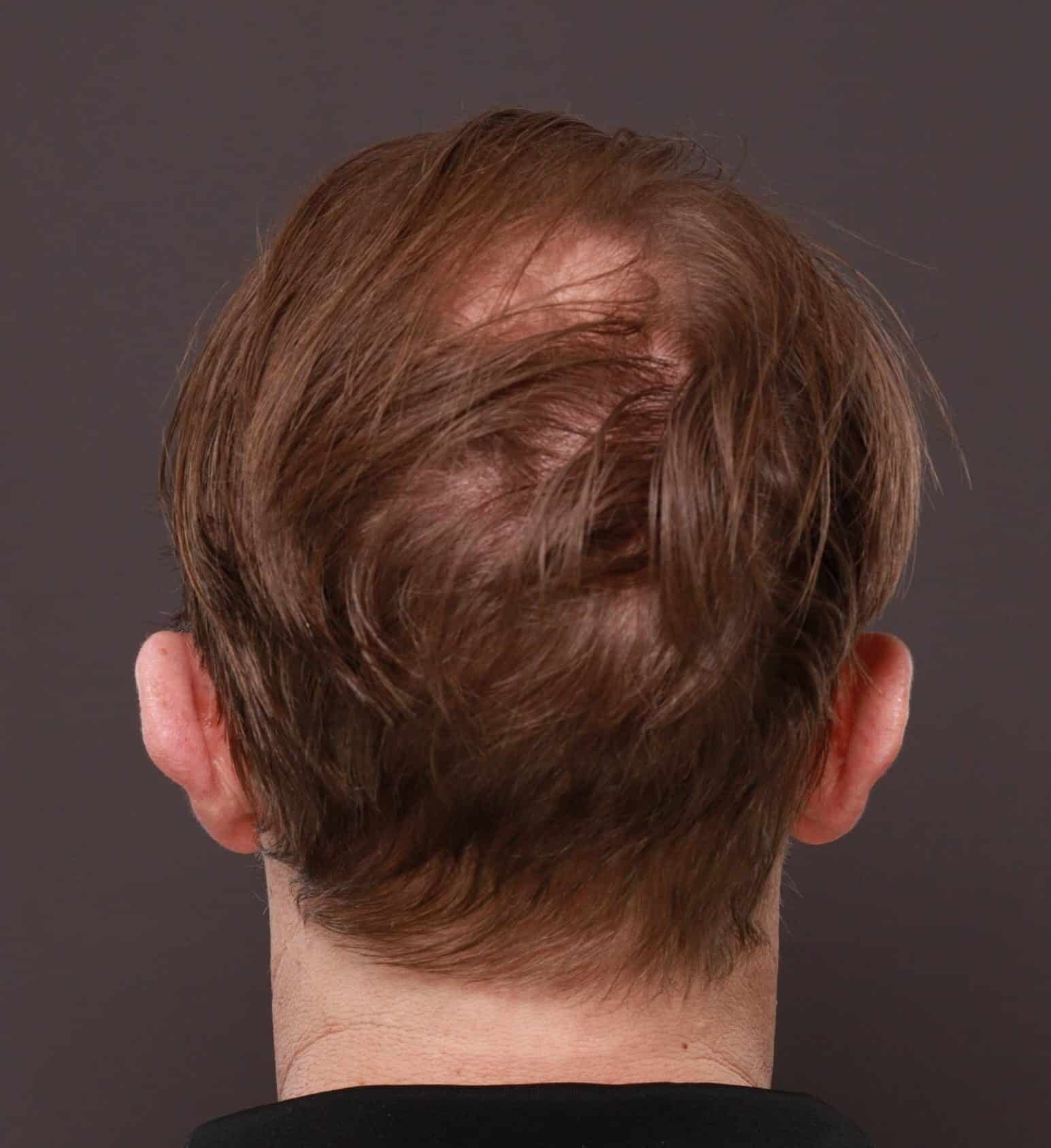 Before Image: FUE Hair Transplant by Dr. Thompson - 