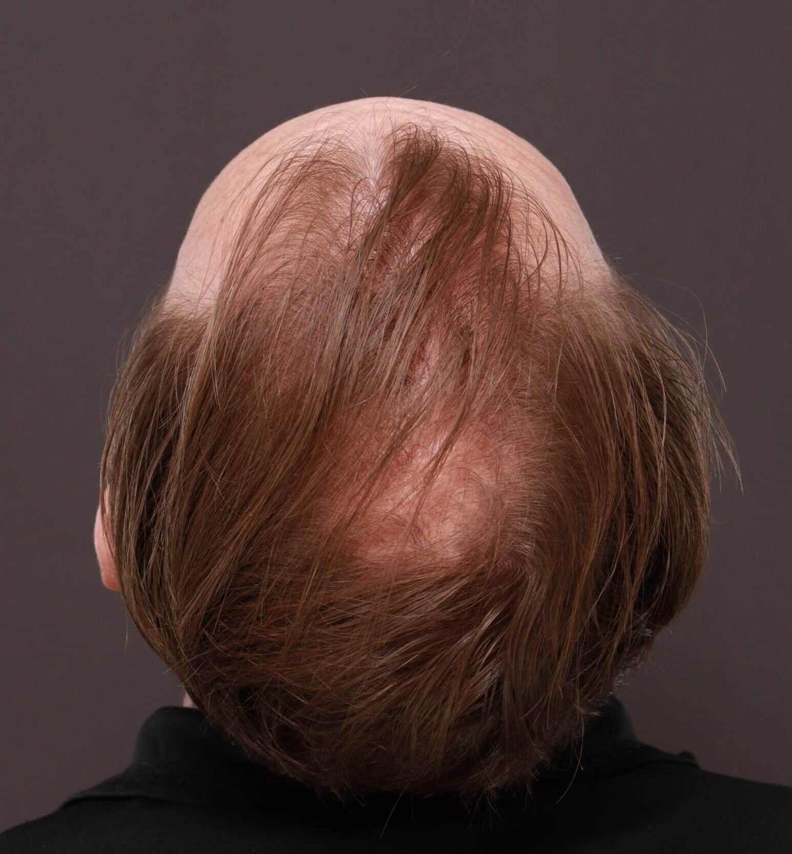 Before Image: FUE Hair Transplant by Dr. Thompson - back
