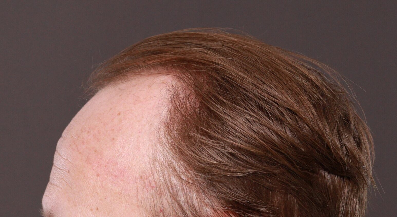 Before Image: FUE Hair Transplant by Dr. Thompson - left-side