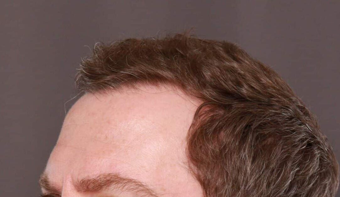 Before Image: FUE Hair Transplant by Dr. Manning - front