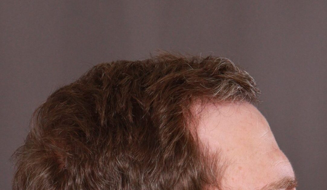 Before Image: FUE Hair Transplant by Dr. Manning - right-side