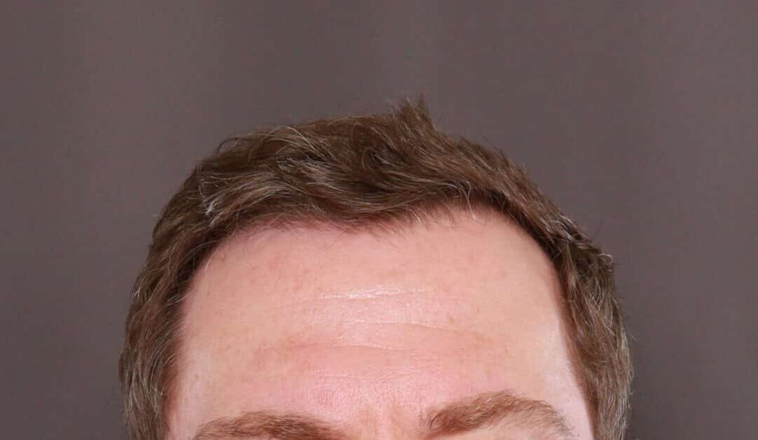 Before Image: FUE Hair Transplant by Dr. Manning - front
