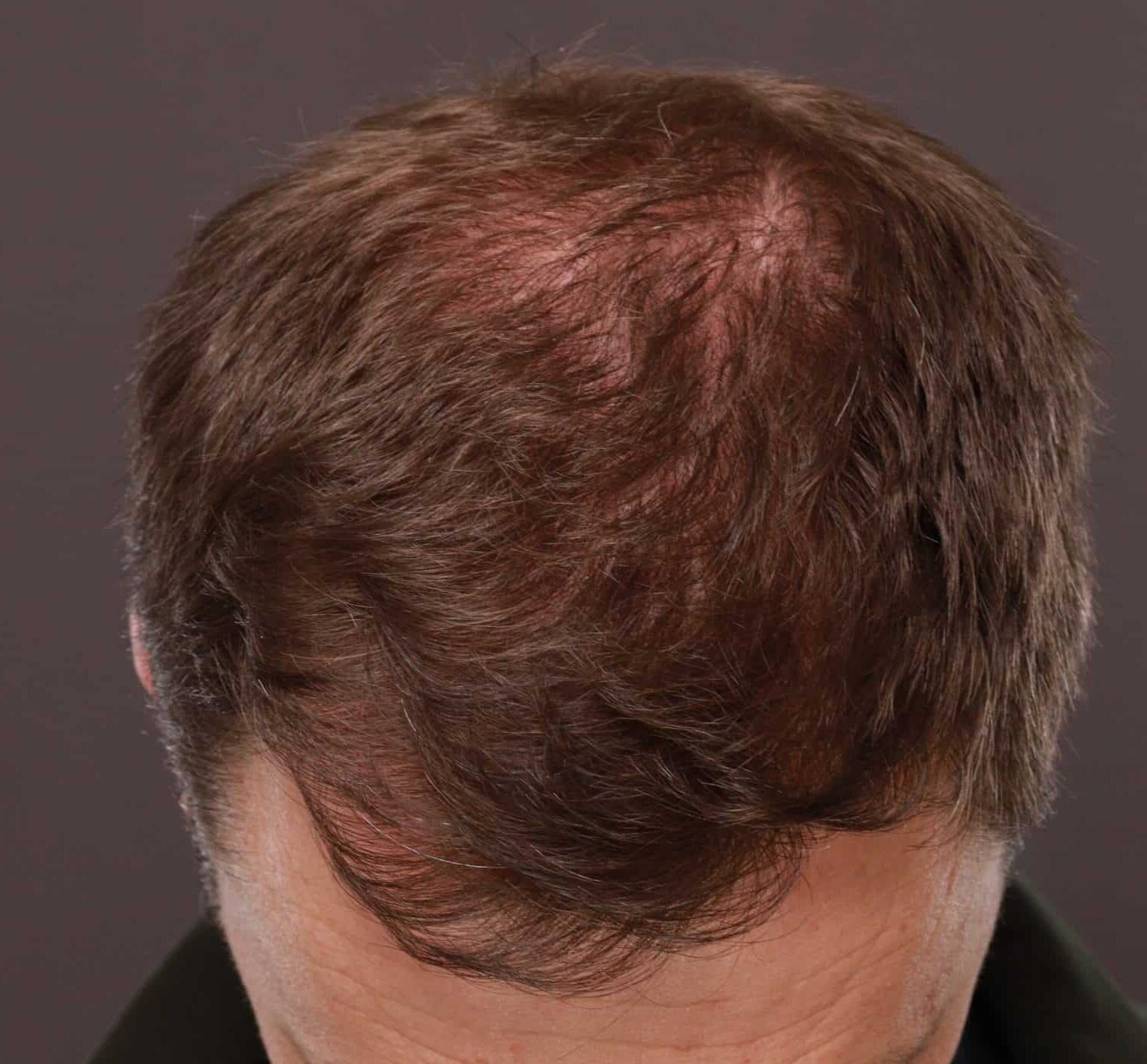 After Image: FUT Hair Transplant by Dr. Thompson - front