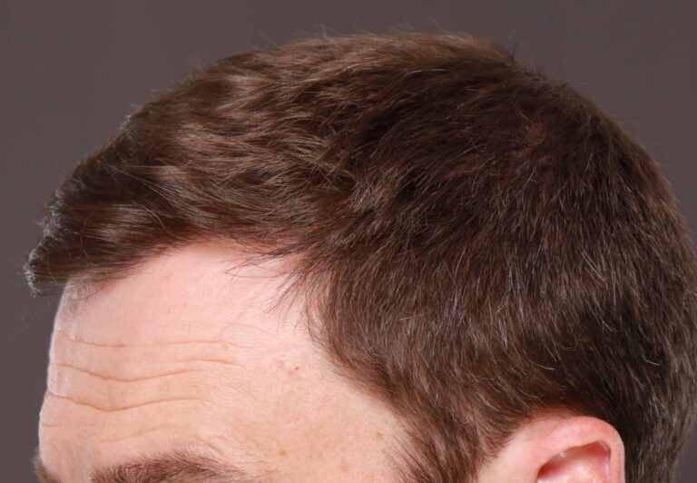 After Image: FUT Hair Transplant by Dr. Thompson - left-front-oblique