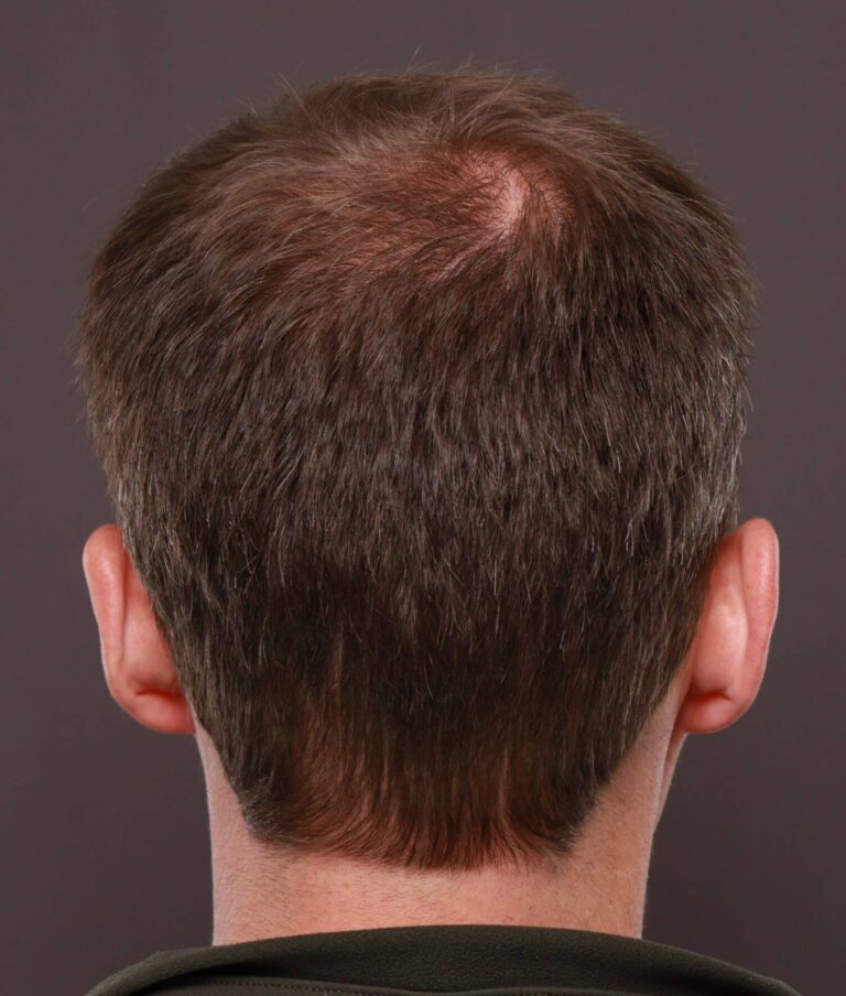 After Image: FUT Hair Transplant by Dr. Thompson - front