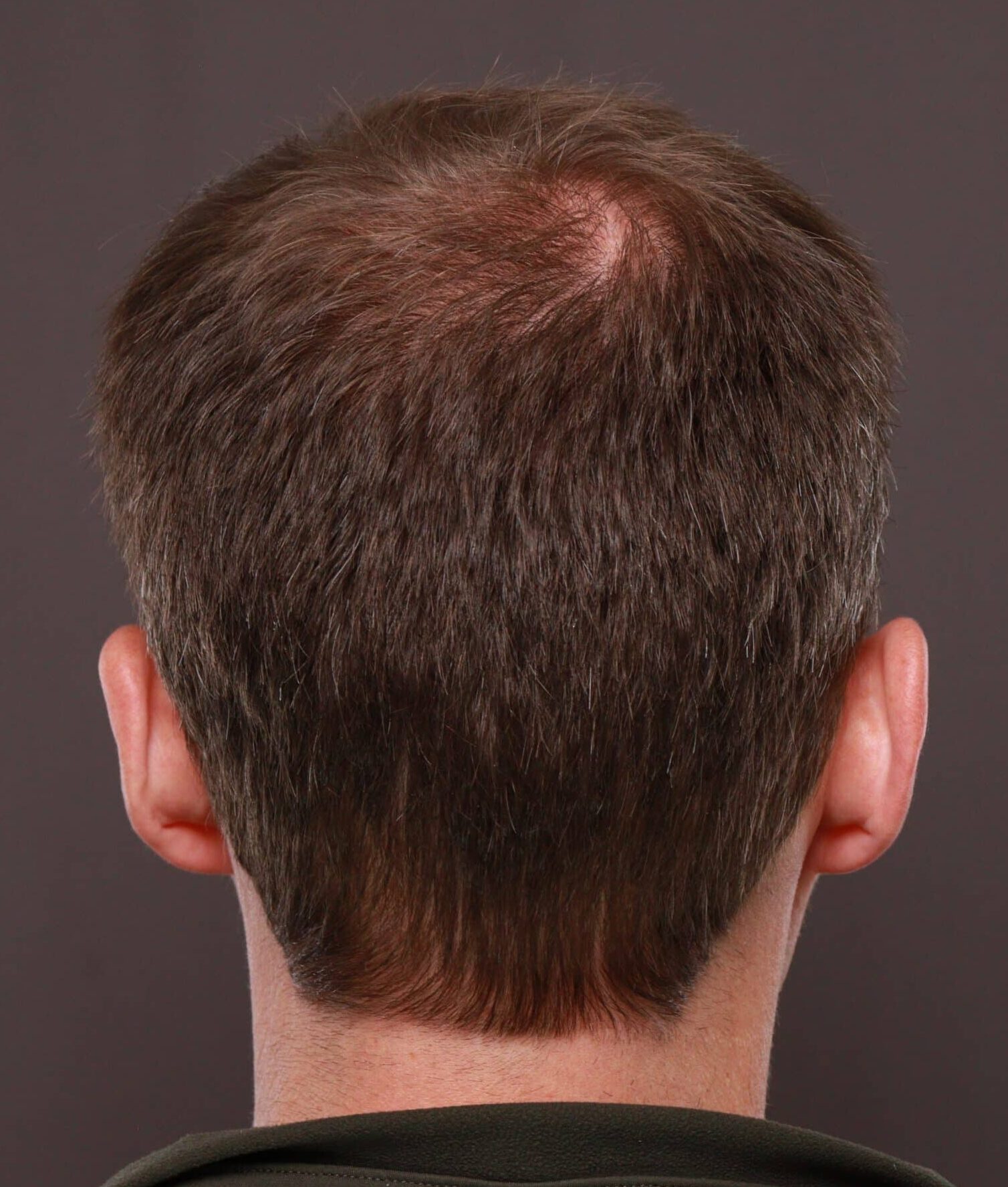 After Image: FUT Hair Transplant by Dr. Thompson - front