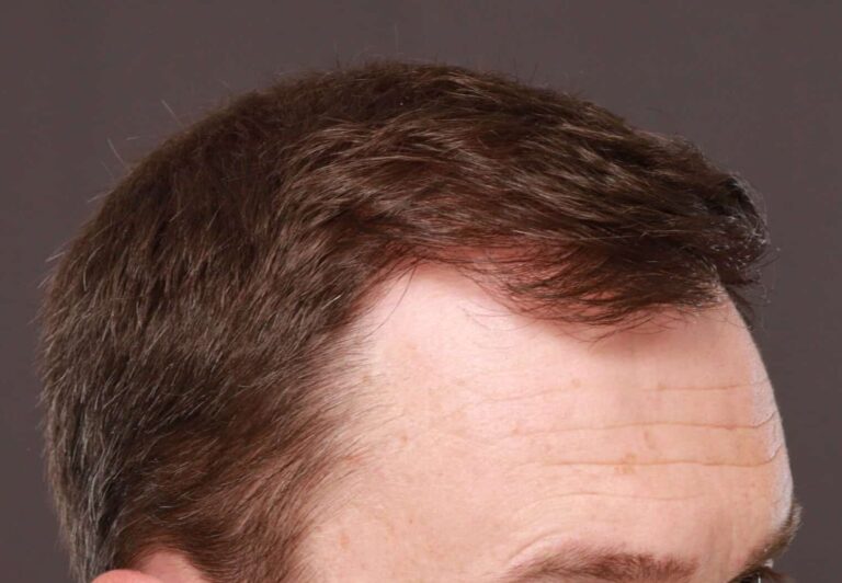 After Image: FUT Hair Transplant by Dr. Thompson - right-front-oblique