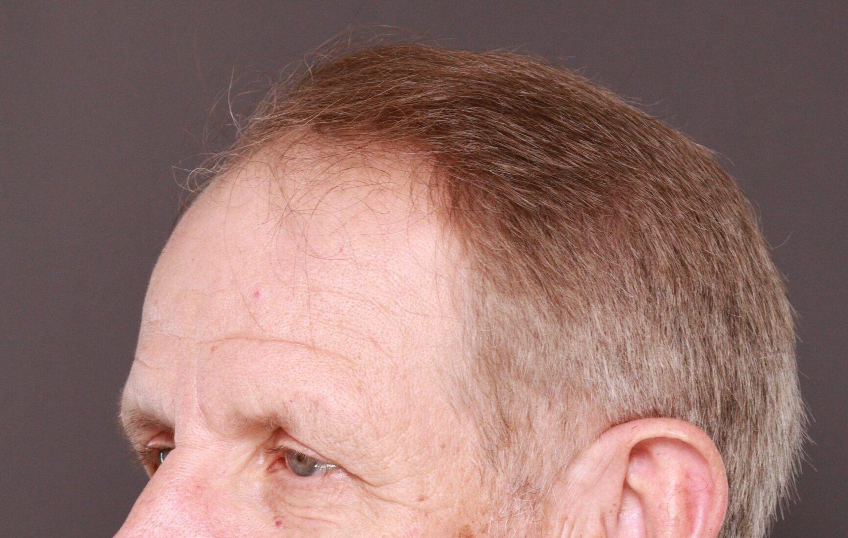 Before Image: Hair and Eyebrow Transplant by Dr. Manning - left-front-oblique
