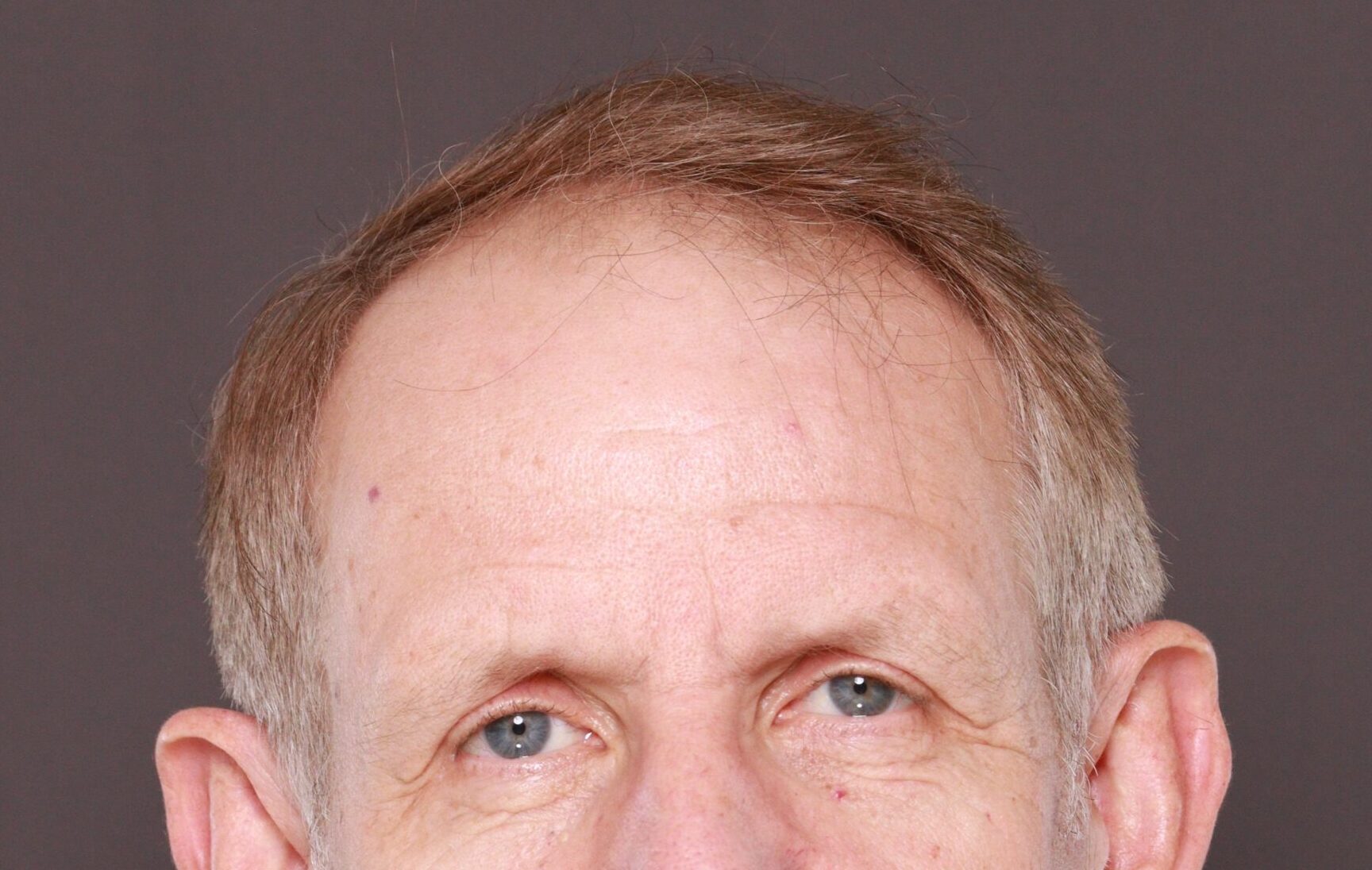 Before Image: Hair and Eyebrow Transplant by Dr. Manning - front