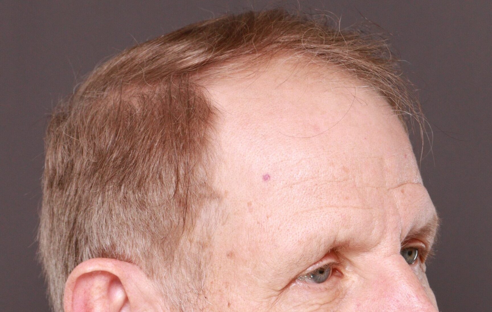 Before Image: Hair and Eyebrow Transplant by Dr. Manning - right-front-oblique