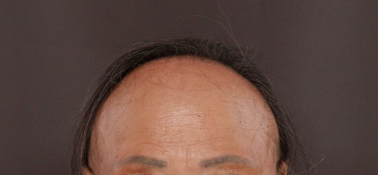 Before Image: FUT Hair Transplant by Dr. Thompson - front