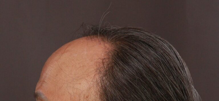 Before Image: FUT Hair Transplant by Dr. Thompson - left-side
