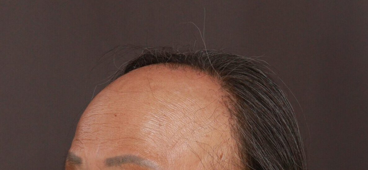 Before Image: FUT Hair Transplant by Dr. Thompson - left-front-oblique