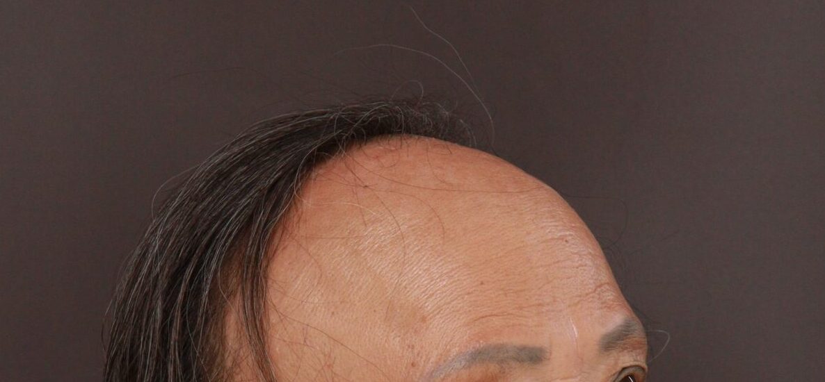 Before Image: FUT Hair Transplant by Dr. Thompson - right-front-oblique