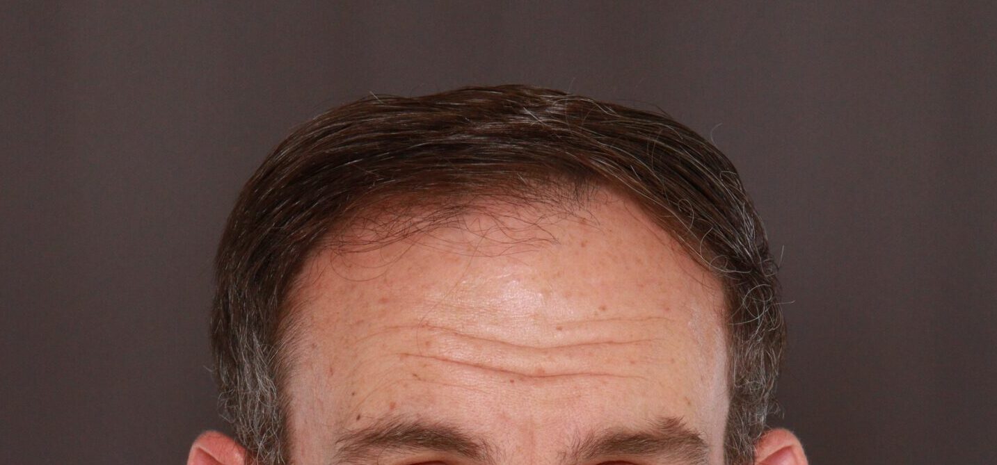 Before Image: FUT Hair Transplant by Dr. Thompson - front