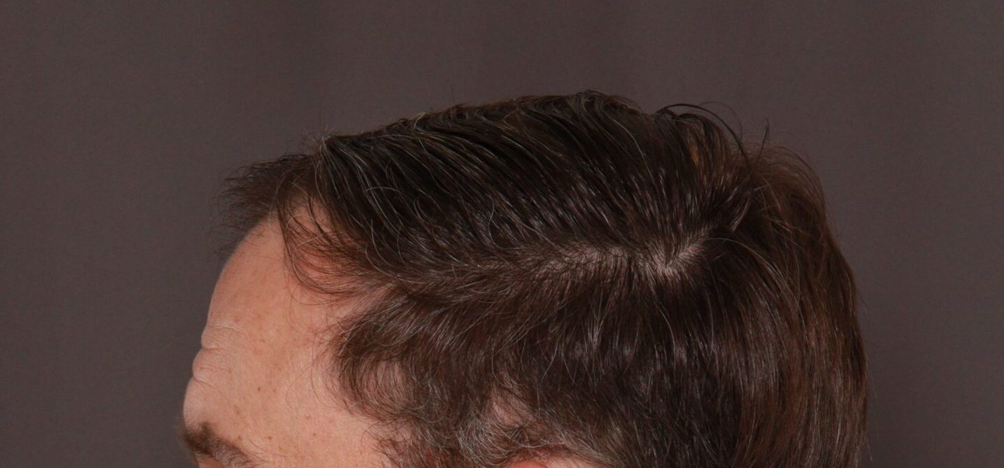 Before Image: FUT Hair Transplant by Dr. Thompson - left-side