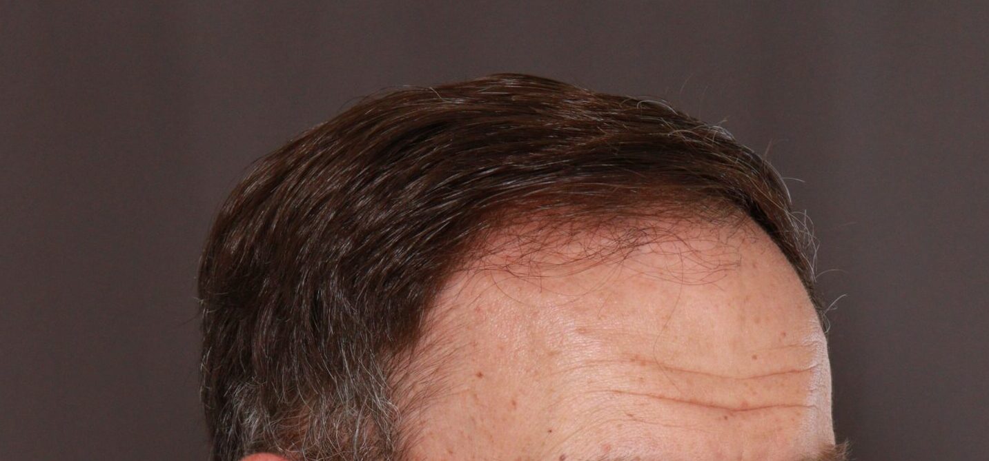 Before Image: FUT Hair Transplant by Dr. Thompson - left-front-oblique