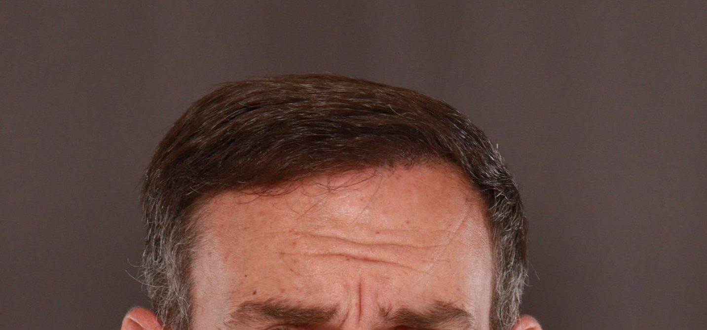 After Image: FUT Hair Transplant by Dr. Thompson - front