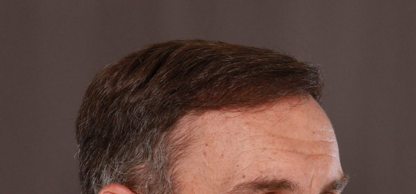 After Image: FUT Hair Transplant by Dr. Thompson - left-front-oblique
