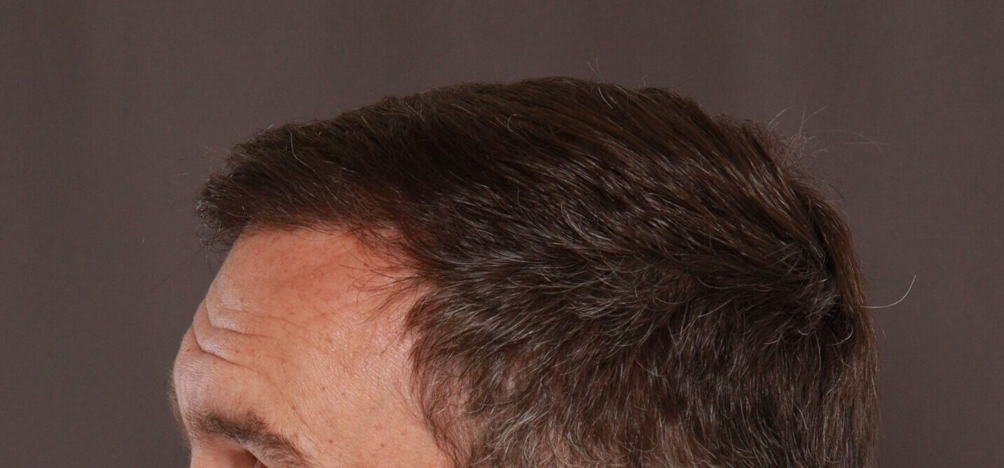After Image: FUT Hair Transplant by Dr. Thompson - left-side
