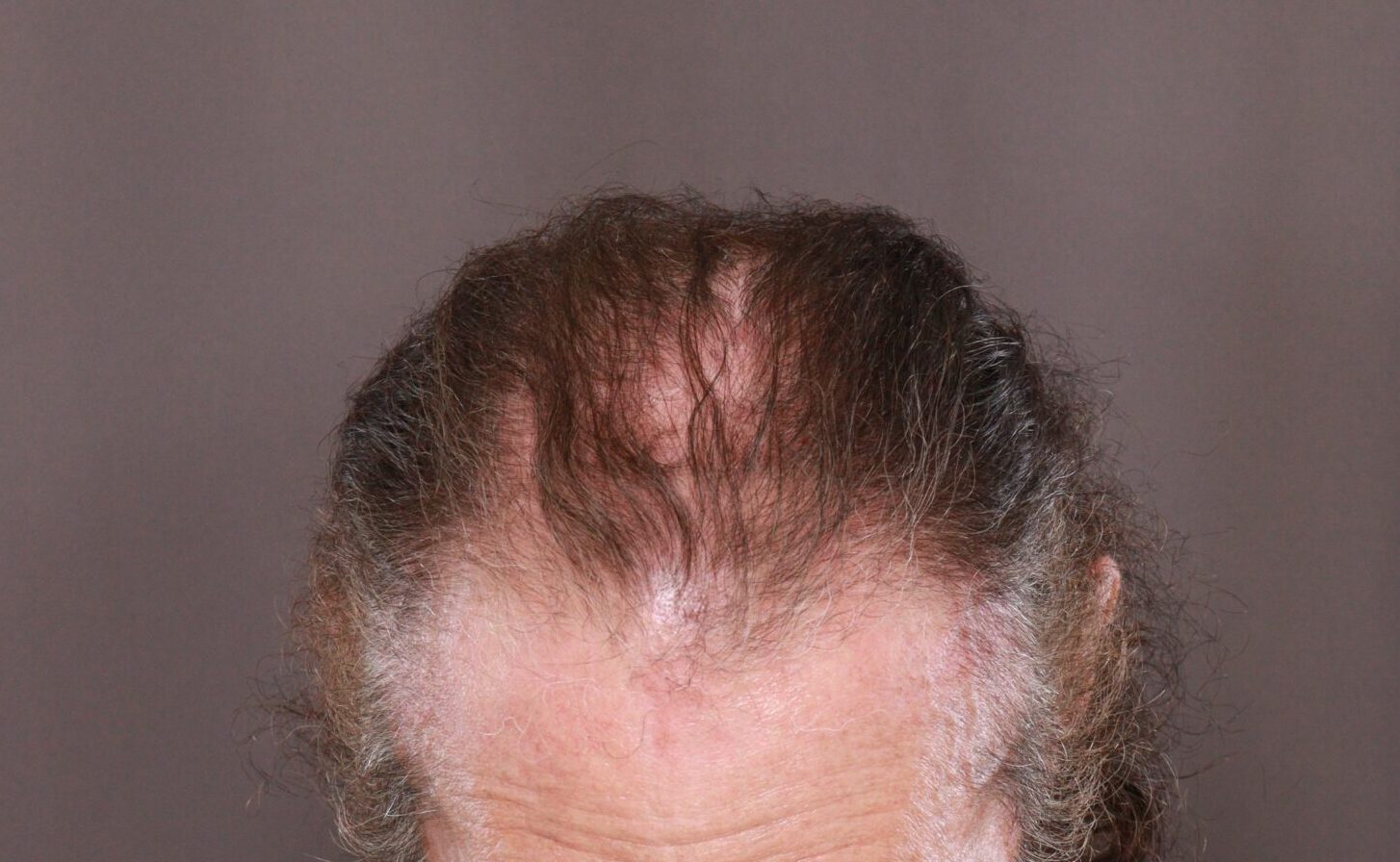 Before Image: FUE Hair Transplant by Dr. Henstrom - front