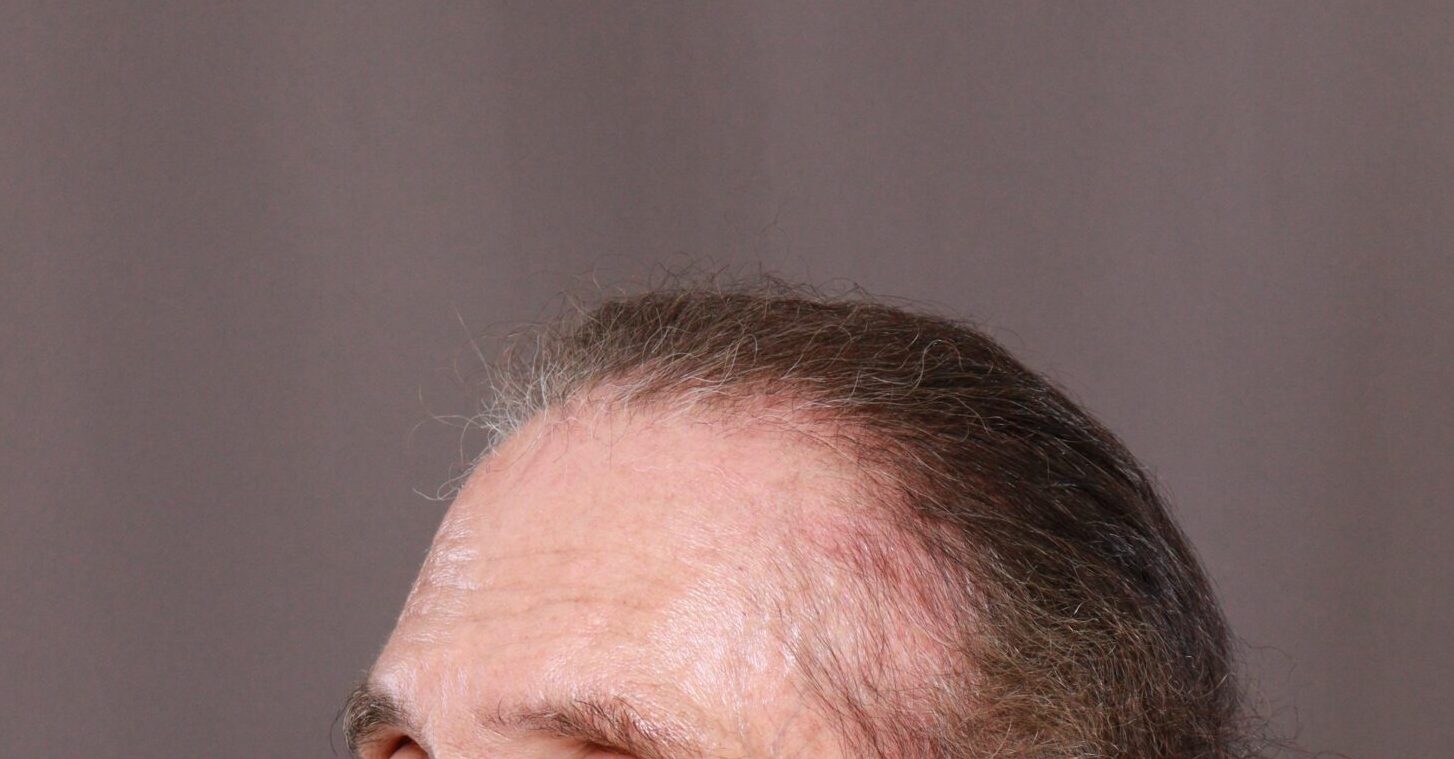 Before Image: FUE Hair Transplant by Dr. Henstrom - left-front-oblique
