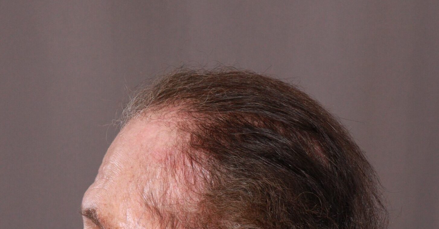 Before Image: FUE Hair Transplant by Dr. Henstrom - left-side