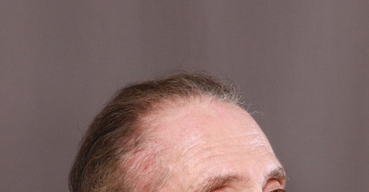 Before Image: FUE Hair Transplant by Dr. Henstrom - right-front-oblique