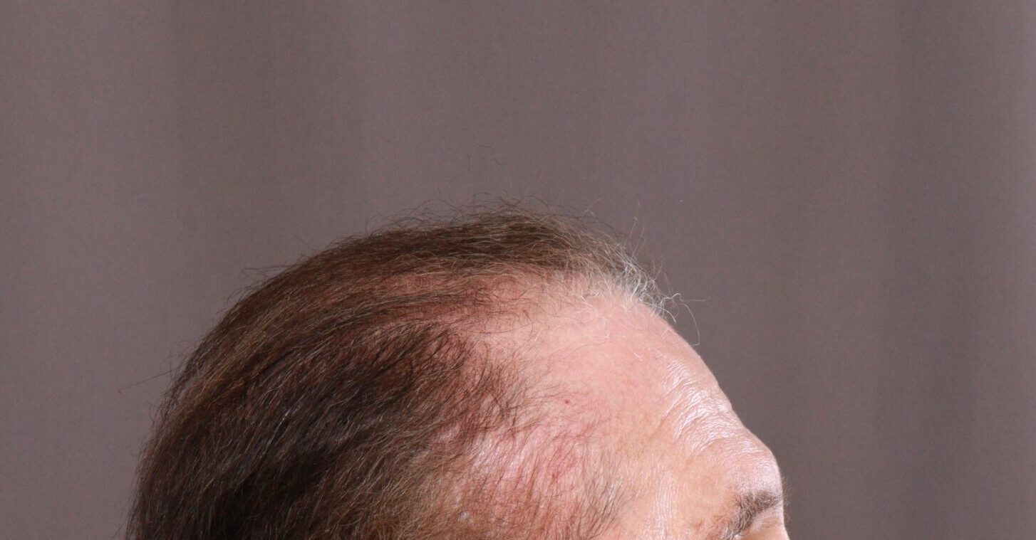Before Image: FUE Hair Transplant by Dr. Henstrom - right-side