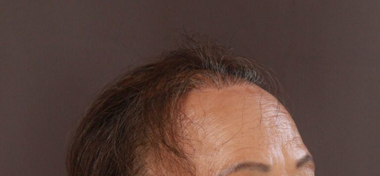After Image: FUT Hair Transplant by Dr. Thompson - right-front-oblique