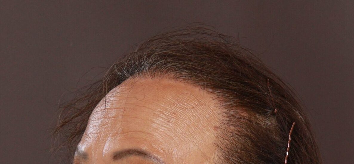 After Image: FUT Hair Transplant by Dr. Thompson - left-front-oblique