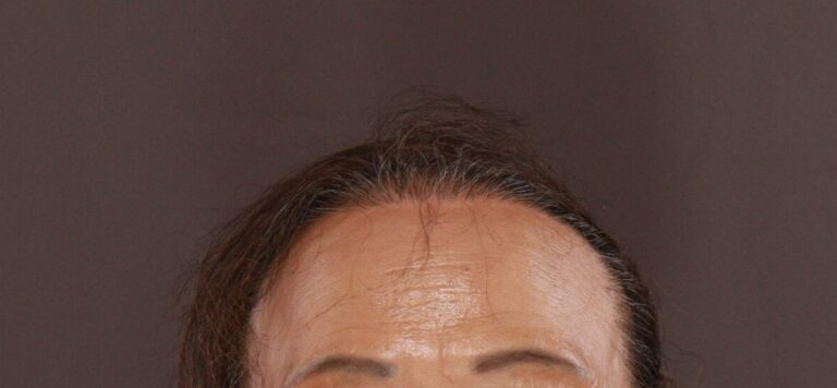 After Image: FUT Hair Transplant by Dr. Thompson - front