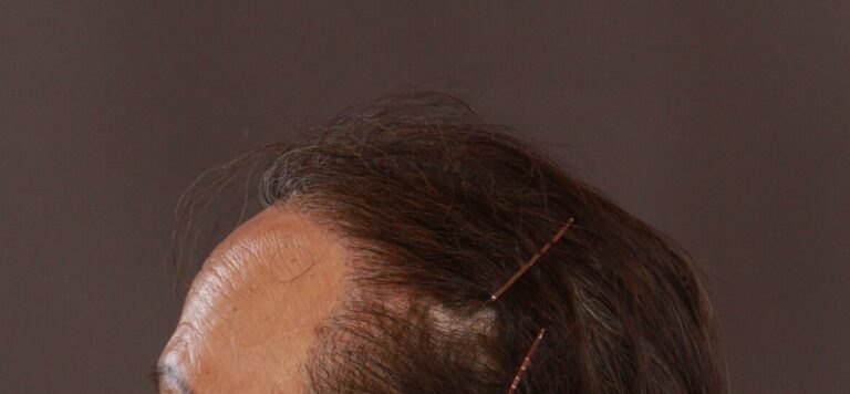 After Image: FUT Hair Transplant by Dr. Thompson - left-side