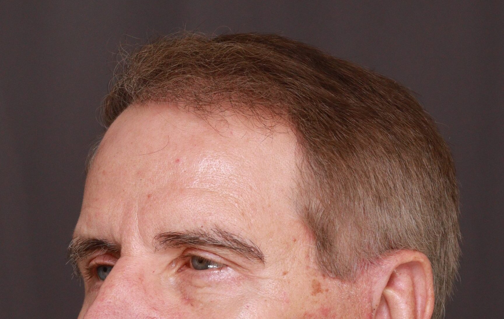 After Image: Hair and Eyebrow Transplant by Dr. Manning - left-front-oblique