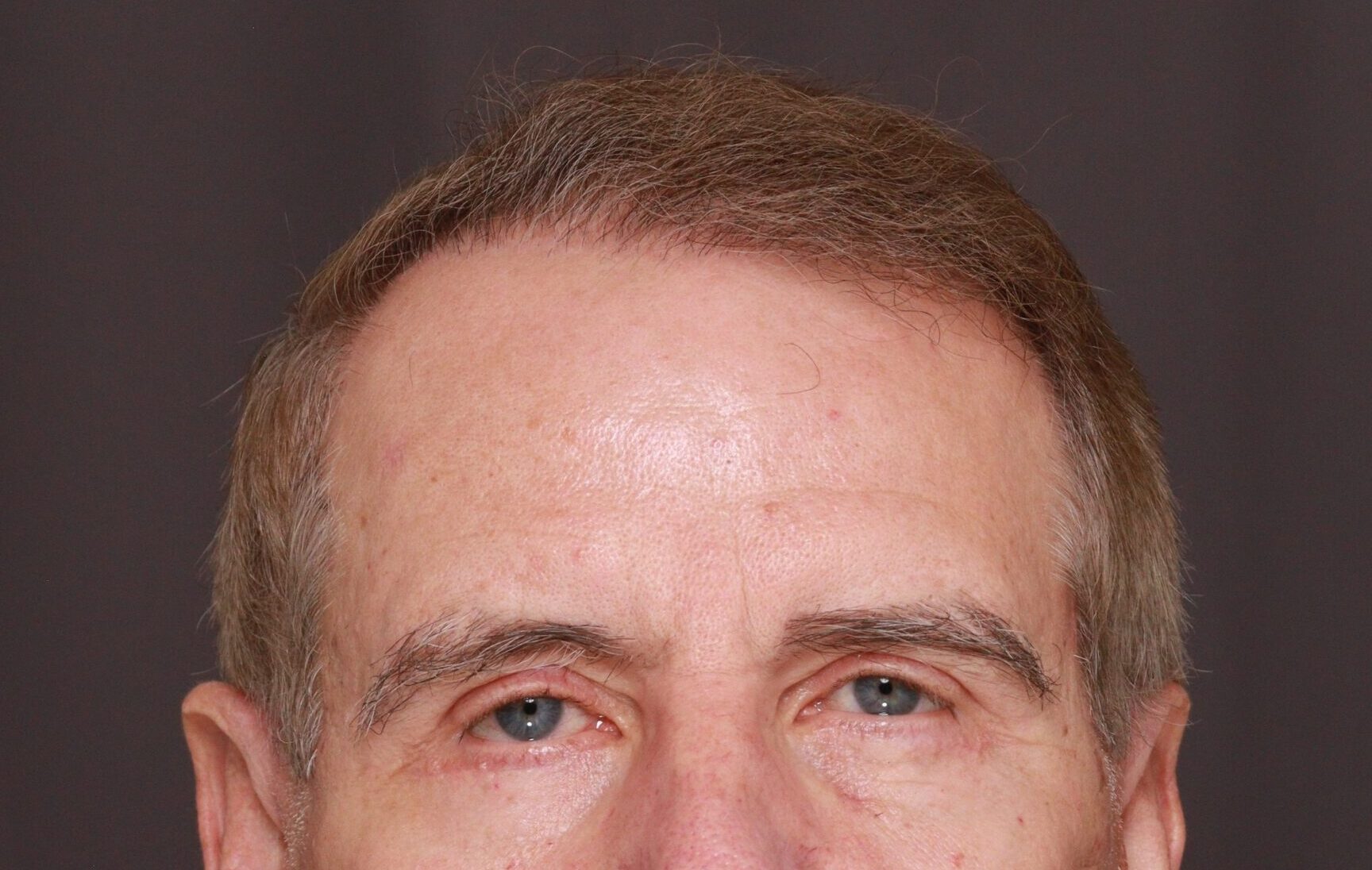 After Image: Hair and Eyebrow Transplant by Dr. Manning - front