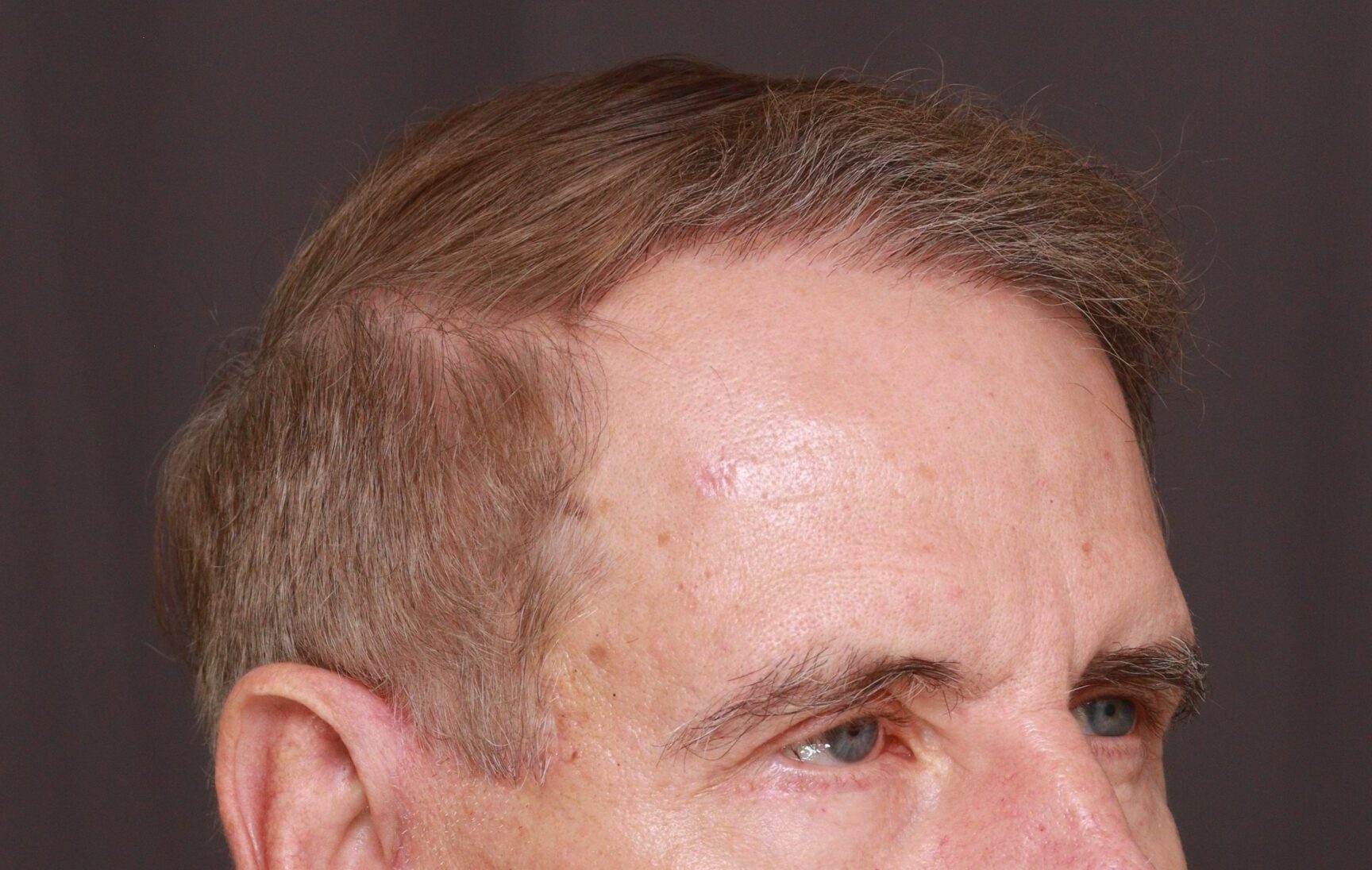 After Image: Hair and Eyebrow Transplant by Dr. Manning - right-front-oblique