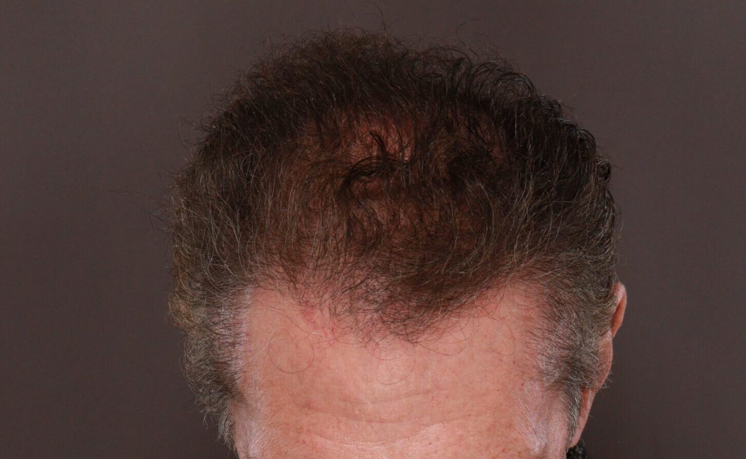 After Image: FUE Hair Transplant by Dr. Henstrom - front