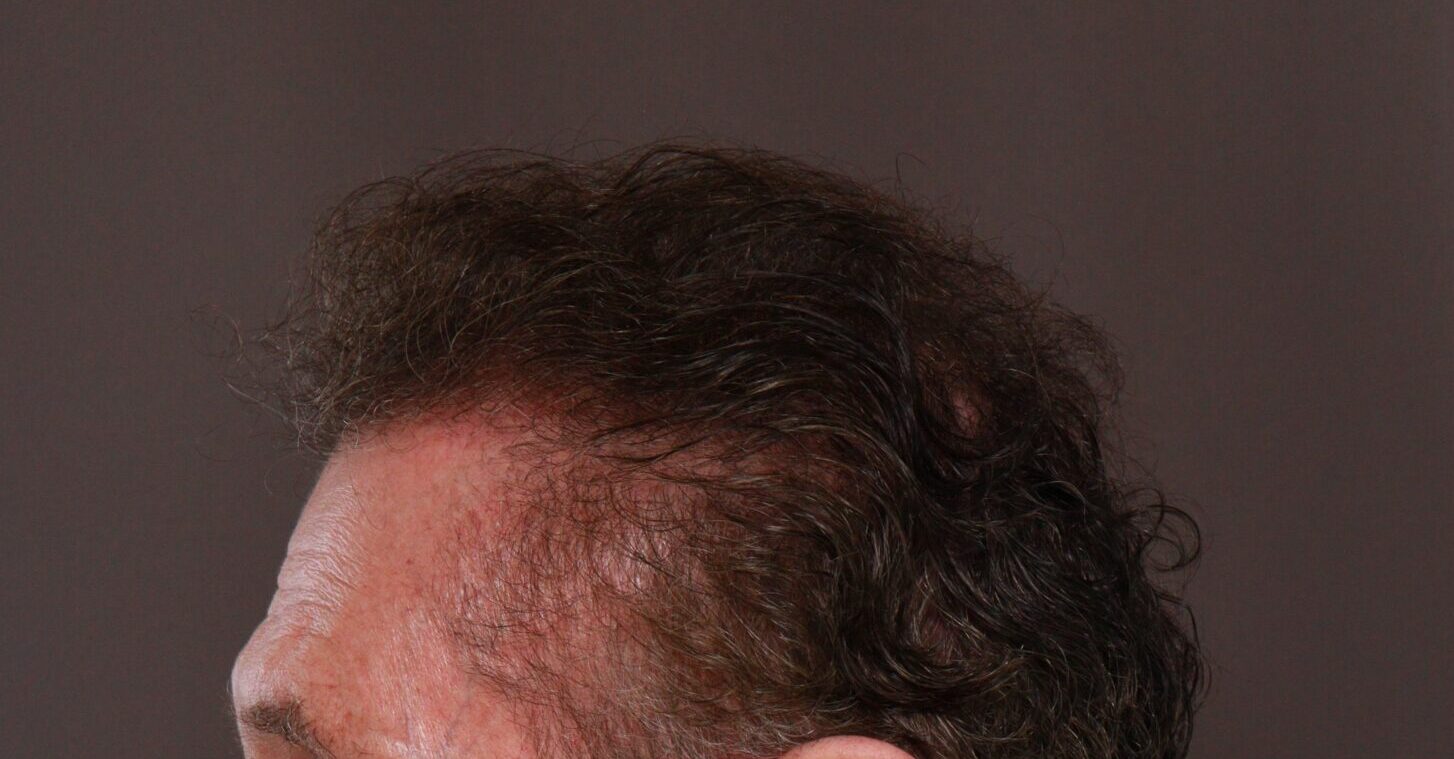 After Image: FUE Hair Transplant by Dr. Henstrom - left-side