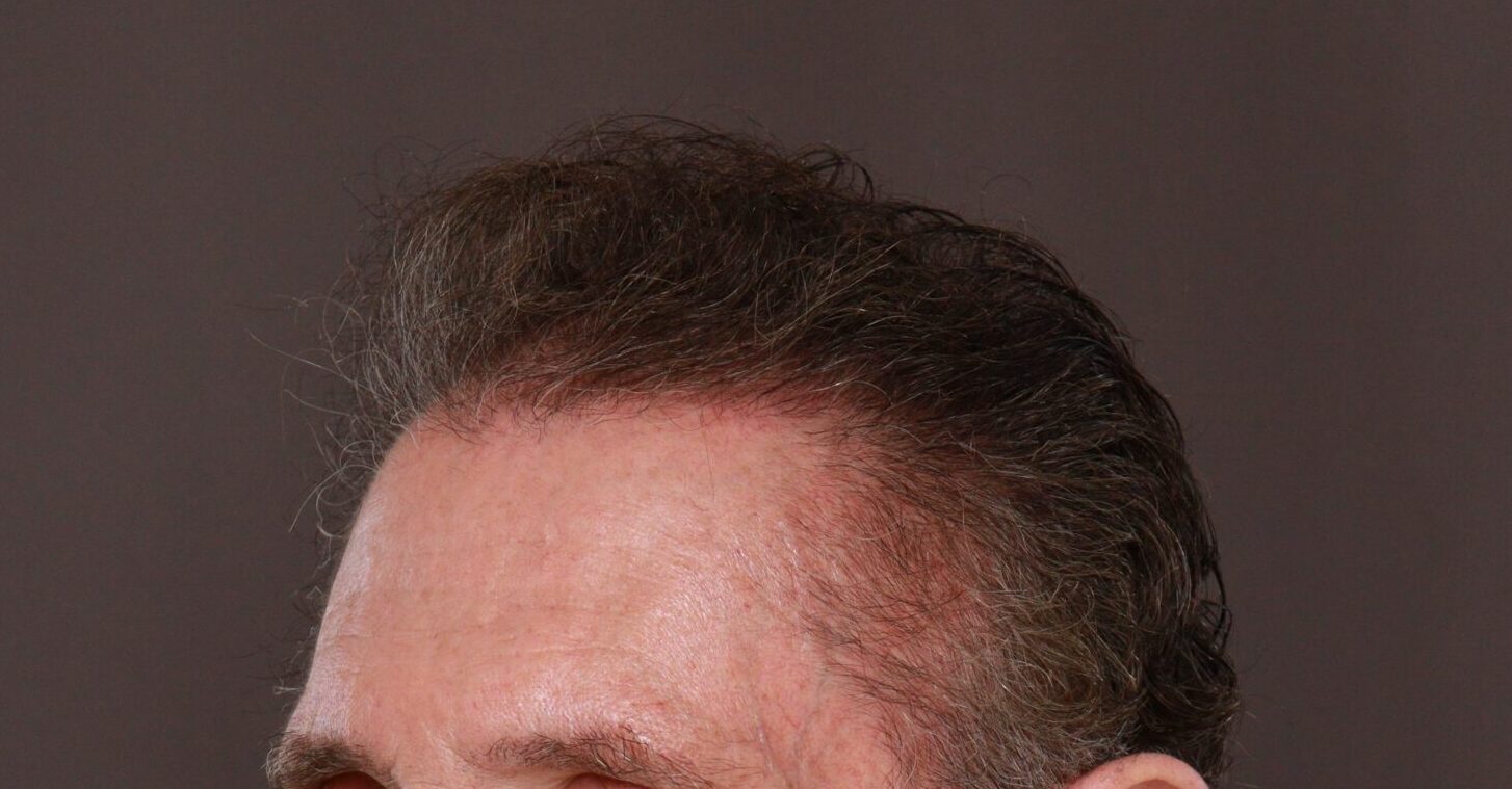 After Image: FUE Hair Transplant by Dr. Henstrom - left-front-oblique