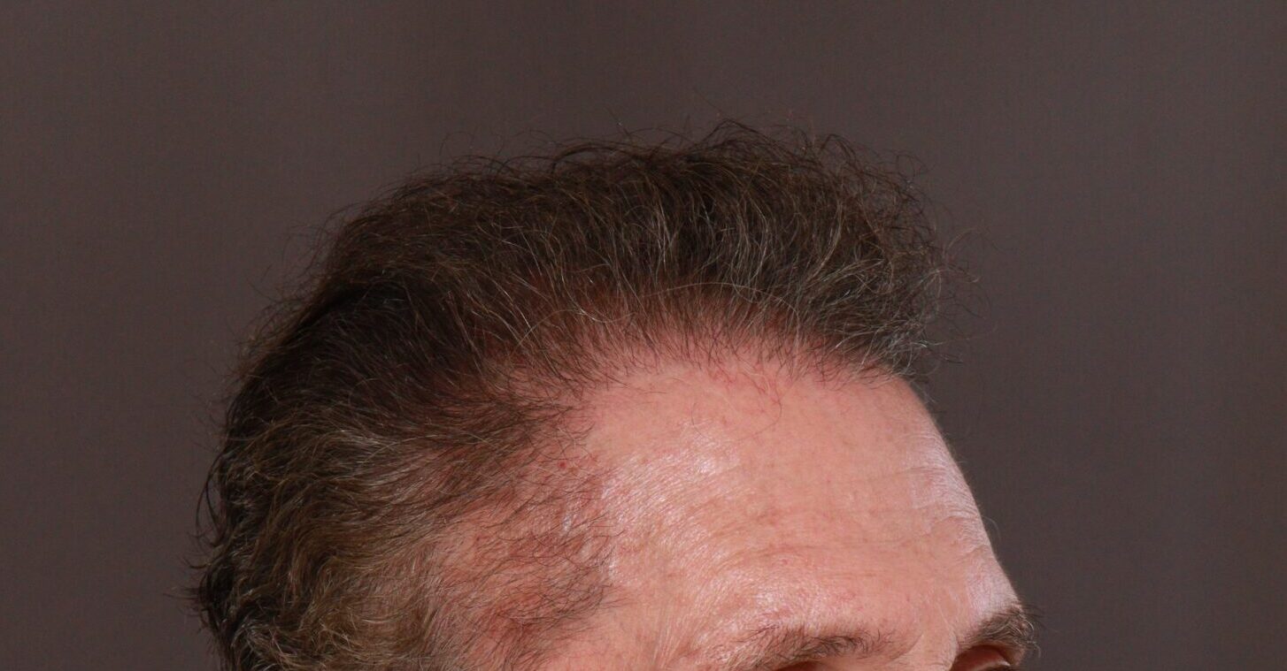 After Image: FUE Hair Transplant by Dr. Henstrom - right-front-oblique