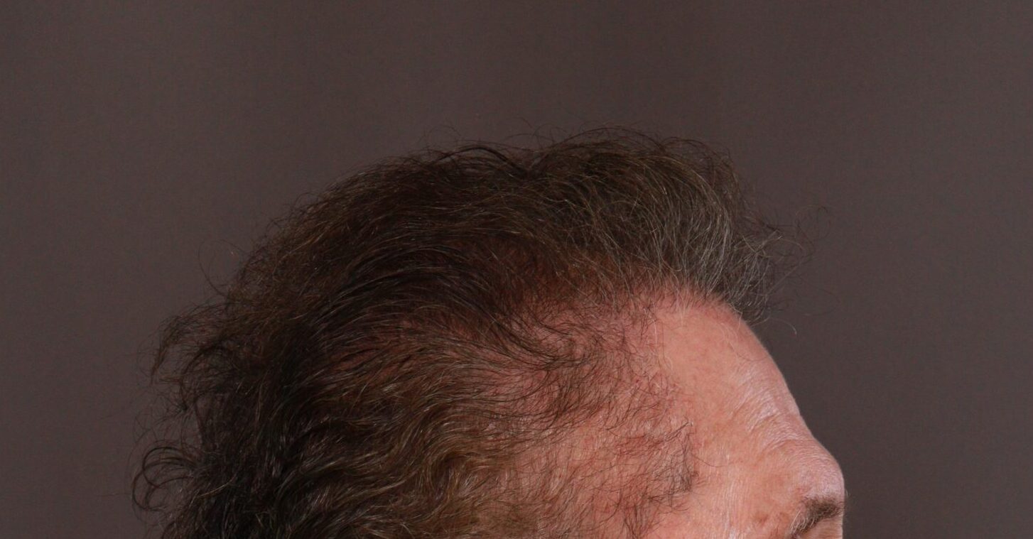 After Image: FUE Hair Transplant by Dr. Henstrom - right-side