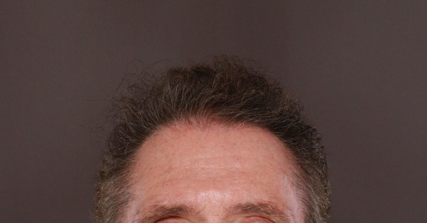 After Image: FUE Hair Transplant by Dr. Henstrom - front