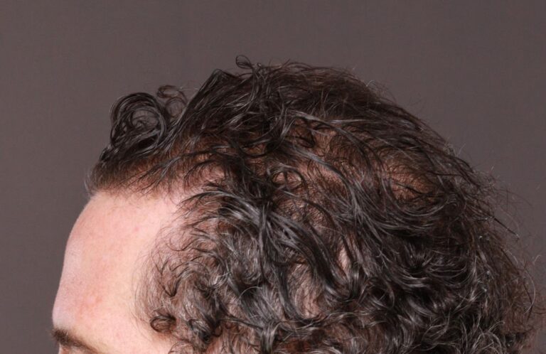 Before Image: FUT Hair Transplant by Dr. Thompson - left-side