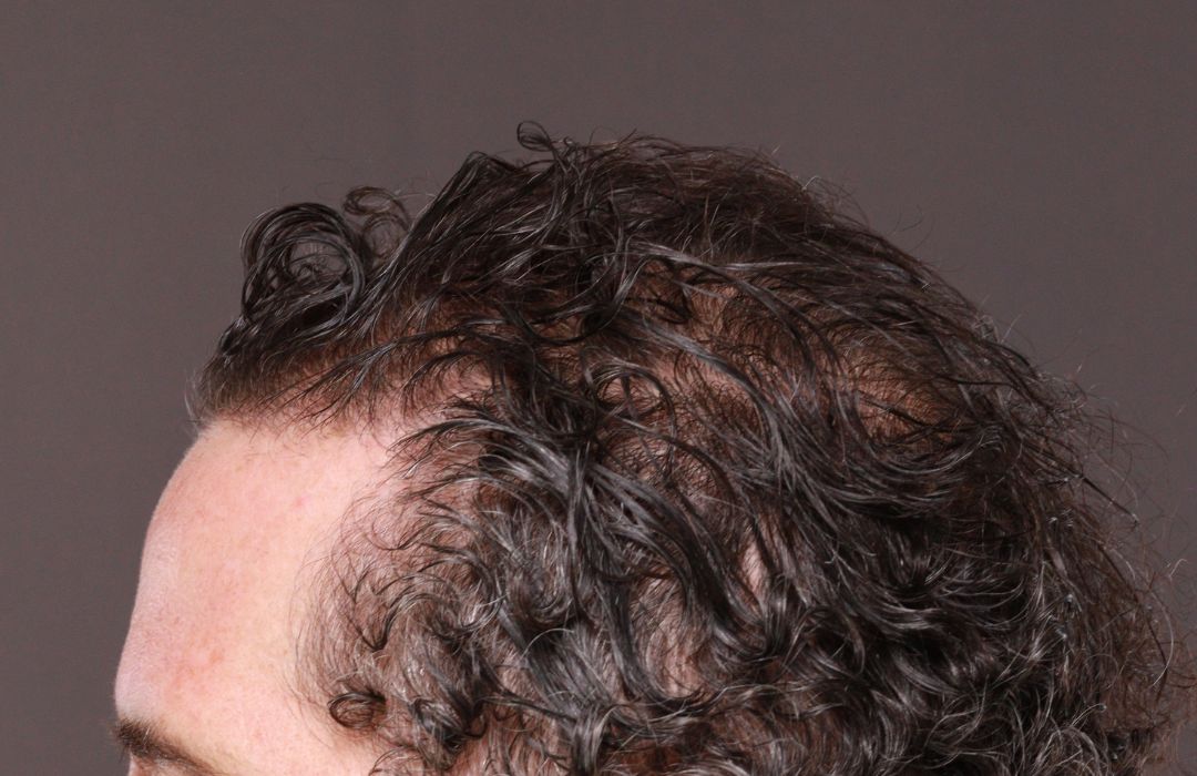 Before Image: FUT Hair Transplant by Dr. Thompson - left-side