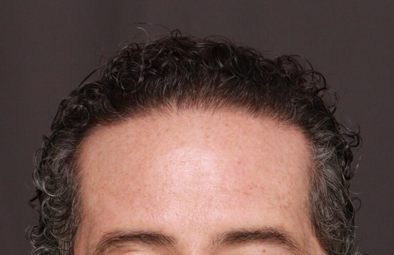 After Image: FUT Hair Transplant by Dr. Thompson - front